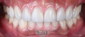 Porcelain Veneers in Toronto by the best cosmetic dentist in Yorkville.018.jpeg