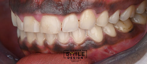 Intraoral Picture of the patient suffering from gummy smile before Smile Makeover from the left side of the patient