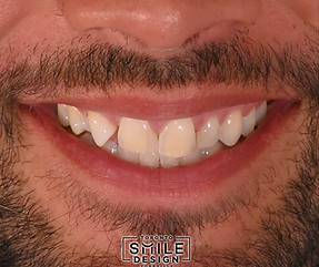 Missing Lateral fix with Porcelain Veneers.001.jpeg