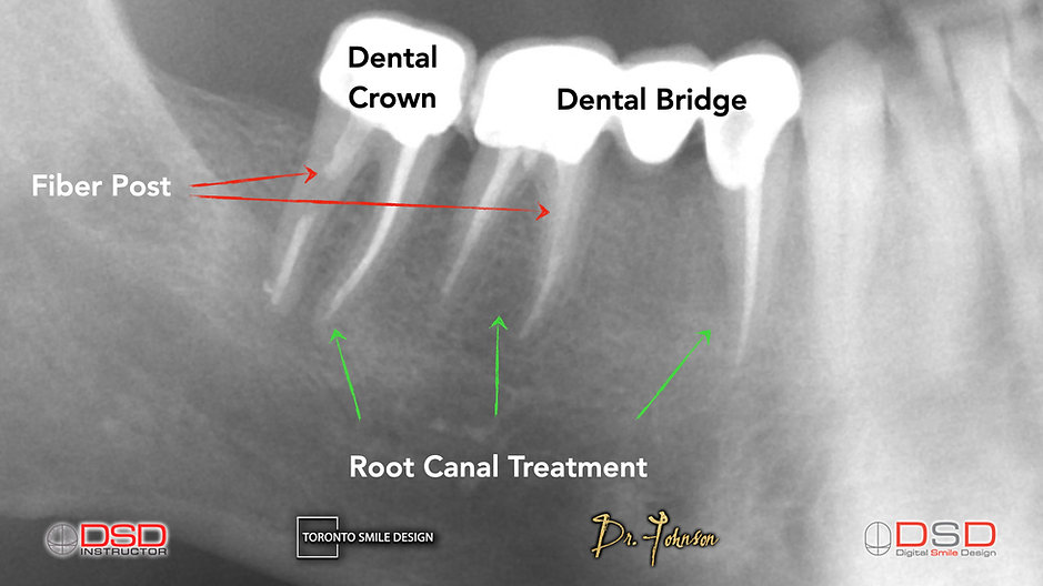 Root Canal Toronto - Toronto Dentist.jpeg