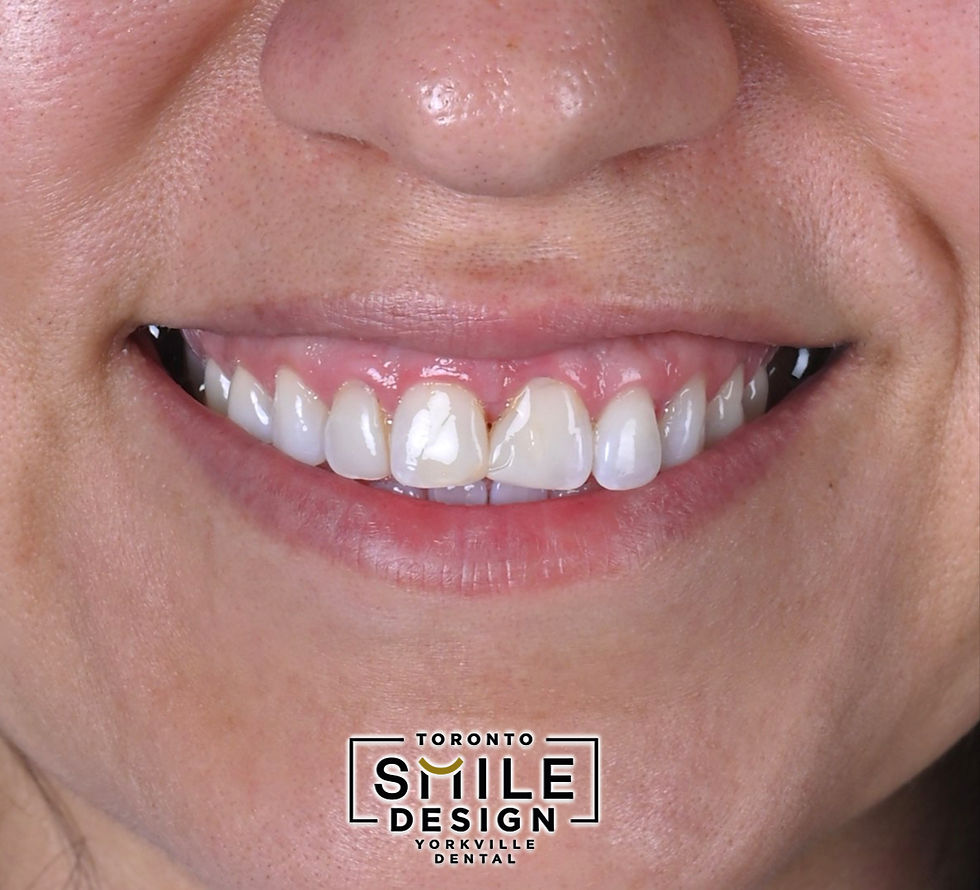 Porcelain Veneer Before and After Pictures in Toronto Yorkville.001