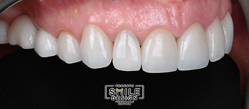 This upper right intraoral photograph captures the pre-treatment starting point from the right side, showing tooth contours, arch form, and any discrepancies in older restorations. At Toronto Smile Design – dentist Yorkville Toronto (near Bloor-Yonge), right-side baseline views help us compare symmetry across the smile, refine incisal edge targets, and plan restorative contours that look natural and function comfortably. For patients researching cosmetic dentistry Toronto, veneers Yorkville, or a smile makeover Toronto, these records demonstrate our planning-first process: we document, design, test through provisionals when needed, and then fabricate final restorations from a proven blueprint.