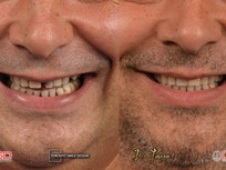 Single Tooth Implants: The Best Solution for Replacing a Missing Tooth?