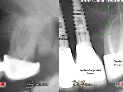 Root Canal: Ultimate Solution for Tooth Pain
