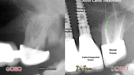 Root Canal - Cold Sensitivity.jpeg