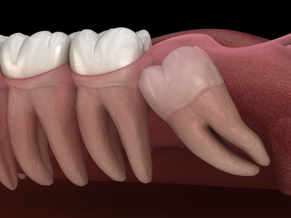 impacted wisdom tooth