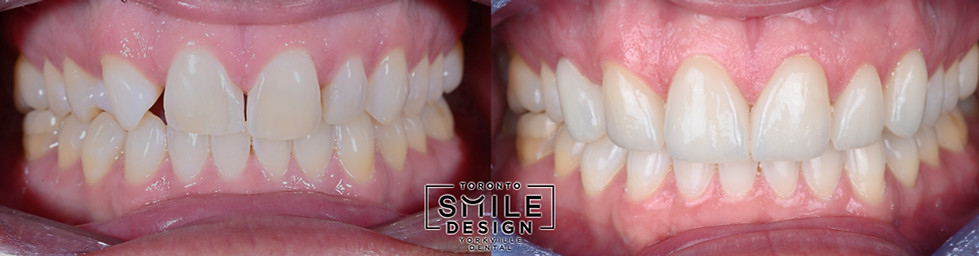 Before and After Pictures of Dental Veneers in Toronto