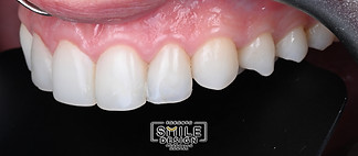 cost of porcelain veneers - 8 Veneers.012.jpeg