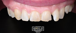 Full Mouth rehabilitation with porcelain crowns and veneers with crown lengthing and fixin