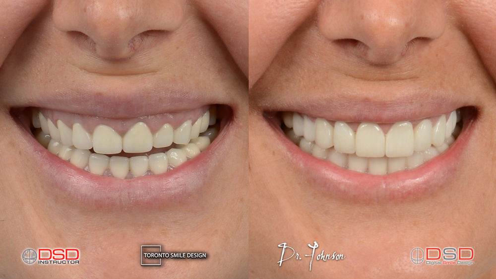 Gummy Smile Laser Gum Contouring and Other Treatment Options