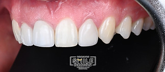 Cosmetic Dentistry in Toronto_edited.jpg