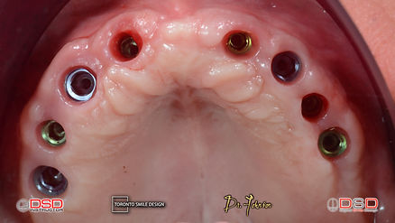 Toronto Dental Implants - Before After.jpeg