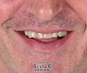 Best Dental Veneers and Porcelain Crowns in Toronto by the best cosmetic dentist.008.jpeg.