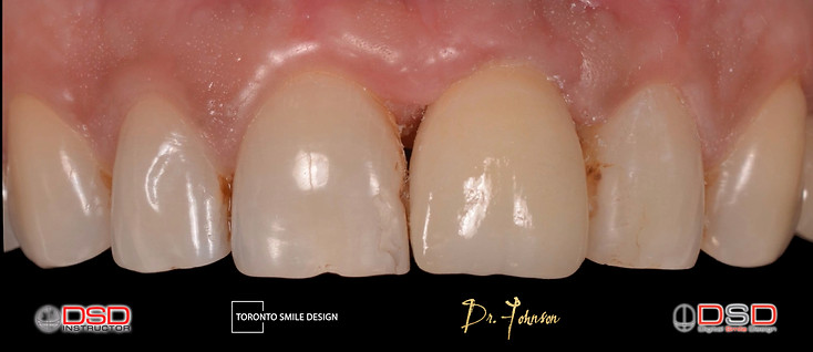 yorkville oral surgeon - dental implants.jpeg