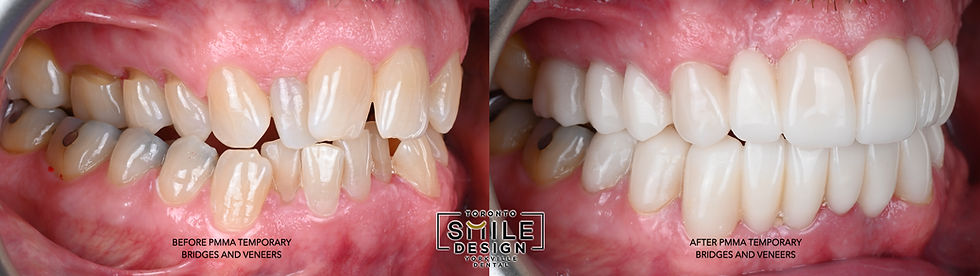 Before-and-after intraoral photographs from the centre, right, and left views showing the patient in long-term PMMA temporaries during healing after extractions. These provisional restorations guided gingival healing, preserved function and aesthetics, and allowed the cosmetic dentist Toronto team to preview and refine the final Smile Makeover Toronto result before delivering the definitive restorations.