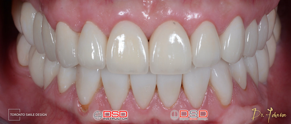 Veneer Toronto - After Veneer Treatment