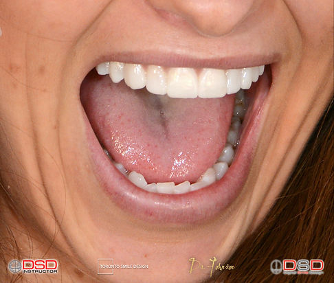Cosmetic Dentist Toronto Case - Veneer T