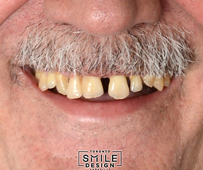 Smile Makeover in Toronto with Porcelain Crown and Dental Implants.001.jpeg