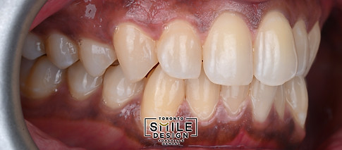 Crowded and malaligned teeth were corrected with porcelain veneer with digital smile desig