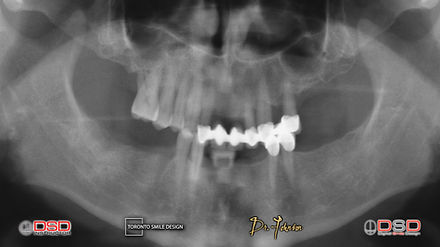 Toronto Dentist Full Mouth Rehabilitation.006.jpeg