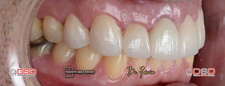 whiten yellow teeth fast - diastema trea