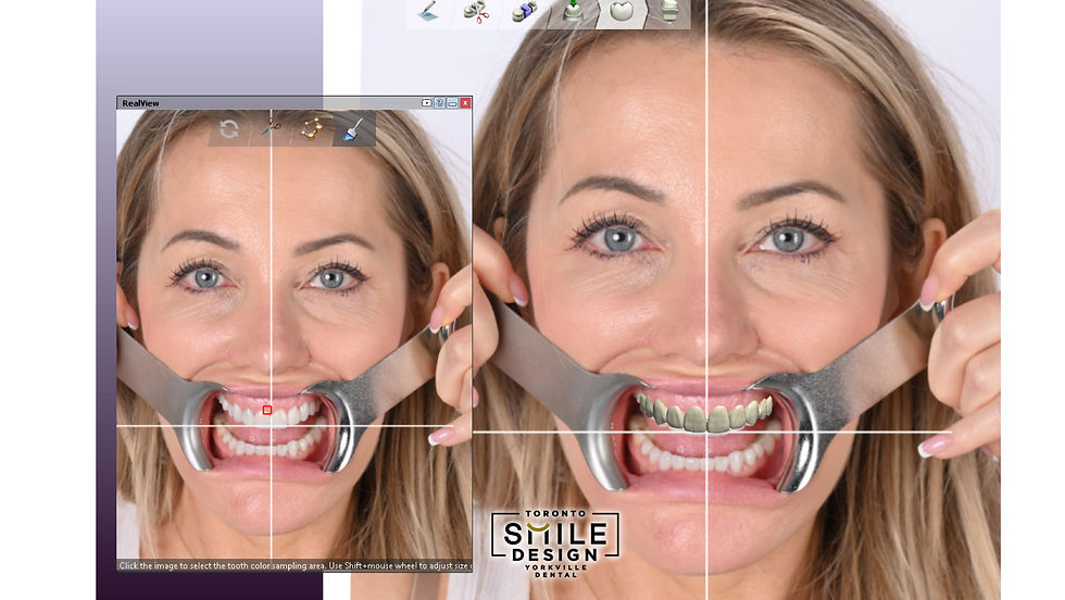 These intraoral design images show the “blueprint stage” of the case—where we digitally plan tooth contours, incisal edge position, and occlusal plane changes before performing irreversible dentistry. At Toronto Smile Design – dental clinic Yorkville (near Bloor-Yonge), we use intraoral design to connect aesthetics with function, especially in cases involving deep bite and bite collapse patterns. By designing digitally first, we can preview how adjusting tooth dimensions and rebuilding occlusal planes supports a more stable bite and more natural tooth display.
For patients searching cosmetic dentistry Toronto, smile makeover Toronto, or a cosmetic dentist Yorkville, these images help explain why planning matters: we can identify discrepancies in symmetry, evaluate how changes will affect the smile arc, and coordinate the design with functional data (including MODJAW movement analysis when indicated). The result is a more predictable plan and a clearer communication bridge between the