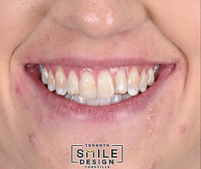 Stained Teeth to White Teeth with Porcelaine Veneers in Toronto by the best Cosmetic Denti