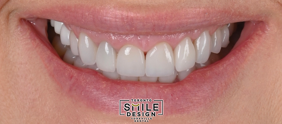 This close-up smile photograph was taken before treatment to document the patient’s starting aesthetics—gum display, gingival line symmetry, and incisal edge proportions. At Toronto Smile Design – dental clinic Yorkville (near Bloor-Yonge), close-up smile photos are a core part of our digital smile design Toronto intake because they capture details that drive predictable planning in gummy smile cases. This baseline helps us evaluate how much gum is visible on each side, how the gumline aligns with the lip line, and whether the incisal edges appear long relative to facial dynamics—especially important when a deep bite pattern can exaggerate tooth display. For patients researching cosmetic dentistry Toronto or a smile makeover Toronto, this image shows the “starting point” we use to design an individualized plan before any irreversible procedures begin.