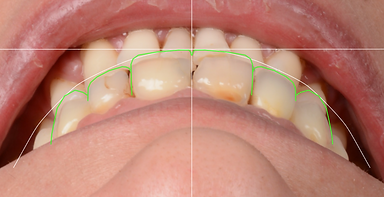 Digital Smile Design Smile Frame