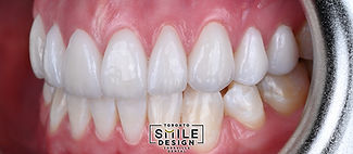 Stained Teeth to White Teeth with Porcelaine Veneers in Toronto by the best Cosmetic Denti