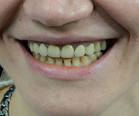Smile Design Case 6 - Toronto Cosmetic D