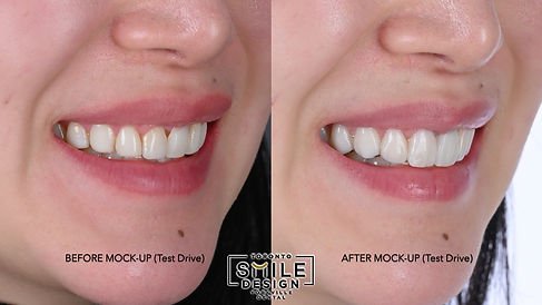 Dental Veneers in Toronto - Implant Supported Crowns in Toronto Yorkville.007.jpeg