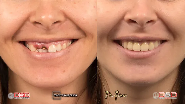 Oral Surgery And Cosmetic Dentistry Fixing Broken Teeth With Toronto Dental Implants