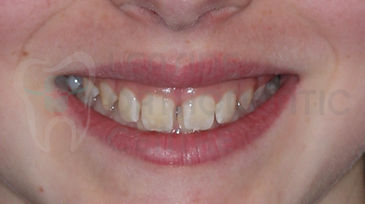 Orthodontic Case No 7 - 14th of October 2019 - Polydiastema case resolved by Toronto Orthodontist Dr. Emel Arat Before The treatment Portrait Picture of the patients smile