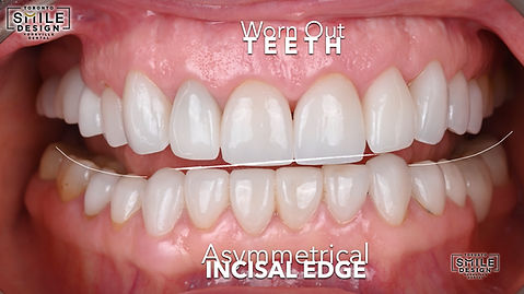 These intraoral photographs capture misaligned older restorations that no longer match the patient’s facial dynamics or functional bite position. In cases like this, restorative work can look “fine” in isolation but still create uneven contacts, an irregular occlusal plane, and instability during chewing—especially when deep bite or bite collapse patterns are present. At Toronto Smile Design – dental clinic Yorkville, we document these issues carefully as part of complex restorative dentistry Toronto and digital smile design Toronto planning. For patients searching for a cosmetic dentist Yorkville, a downtown Toronto dentist, or a dentist near Bloor Yonge, these clinical images help explain why a planning-first approach matters: we assess how existing restorations influence occlusion, tooth display, and gumline symmetry before building a stable full mouth reconstruction Toronto plan and designing the final restorations.