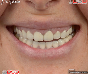 Dental Crowns with Crown Lengthening Procedure.001.jpeg