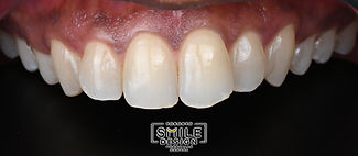 Crowded and malaligned teeth were corrected with porcelain veneer with digital smile desig