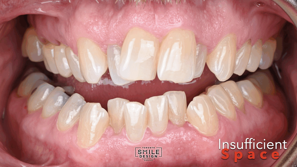 Intraoral GIF showing the severe lack of space created by the lateral incisors in a complex Smile Makeover Toronto case. This dynamic close-up documentation helped the cosmetic dentist Toronto team evaluate the extent of crowded teeth, teeth malignment, and spatial limitations before proceeding with advanced cosmetic dentistry treatment and restorative smile design.
