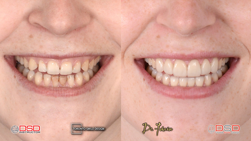 Best cosmetic dentist toronto - Gum contouring patient before and after pictures of laser crown lengthening