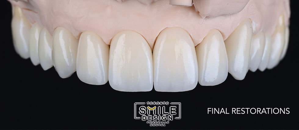 Best Dental Veneers and Porcelain Crowns in Toronto by the best cosmetic dentist.008.jpeg.