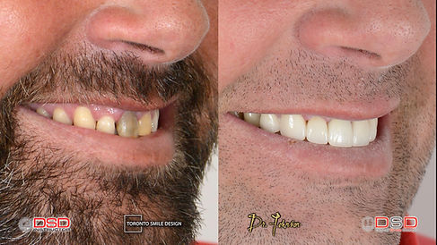 midline shift teeth - gap teeth - do por