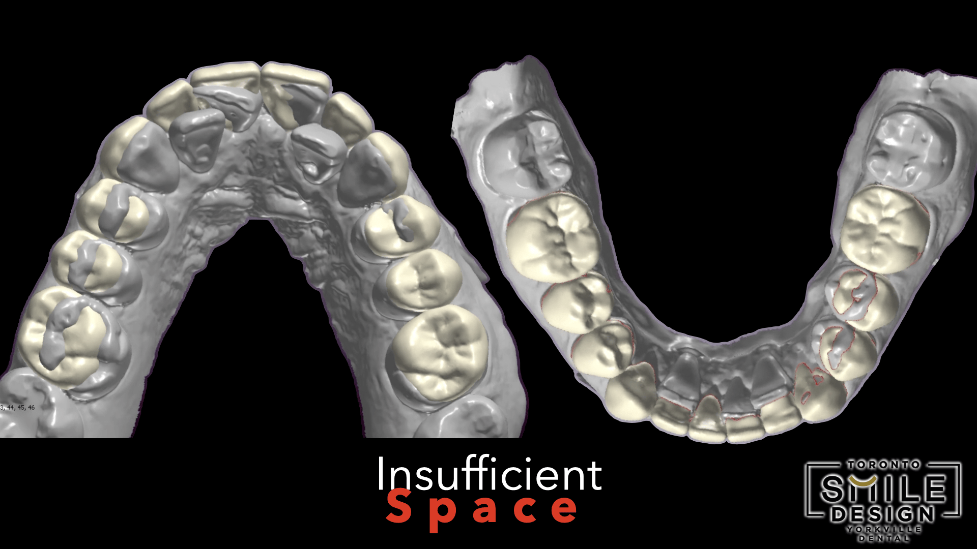 Occlusal-view GIF of the patient’s intraoral impressions, used during the digital planning phase of a complex Smile Makeover Toronto case. This perspective revealed severe crowded teeth, teeth malignment, and limited restorative space, helping the cosmetic dentist Toronto team design a precise cosmetic dentistry treatment plan before starting the case.
