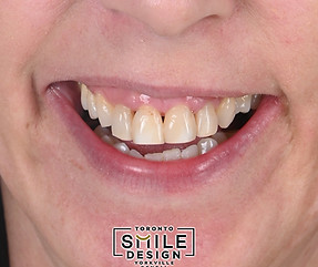 Cosmetic Dentistry in Toronto by the cosmetic dentist Dr Johnson.001.jpeg
