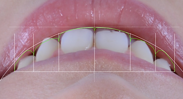 Digital Smile Design Smile Frame