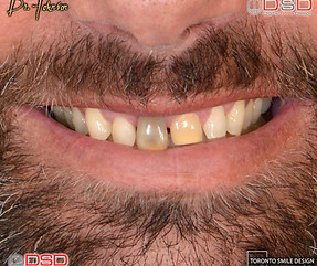 how to fix gap teeth - Porcelain Crowns 