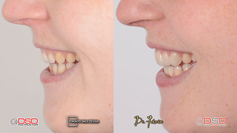 Toronto Veneers provided by the top cosmetic dentist Dr Johnson