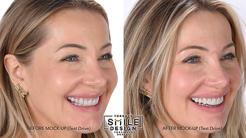 This right-side portrait comparison shows the patient before the mock-up and after the diagnostic mock-up preview. At Toronto Smile Design – dentist Yorkville Toronto (near Bloor-Yonge), side views are critical because they reveal how the smile interacts with the lips and facial profile—especially in cases where deep bite patterns influence tooth display and lower facial support.
The mock-up phase is designed to validate the dimensions of the proposed smile: incisal edge position, smile arc, and overall proportion. It may look slightly matte or bulky compared to the final restorations because it is a planning tool—not the finished ceramic texture and polish. For patients researching cosmetic dentistry Toronto, smile makeover Toronto, or veneers Yorkville, this right-side before-and-after preview illustrates how digital smile design Toronto helps patients see the “blueprint” first, then move forward with a more predictable, individualized treatment plan.