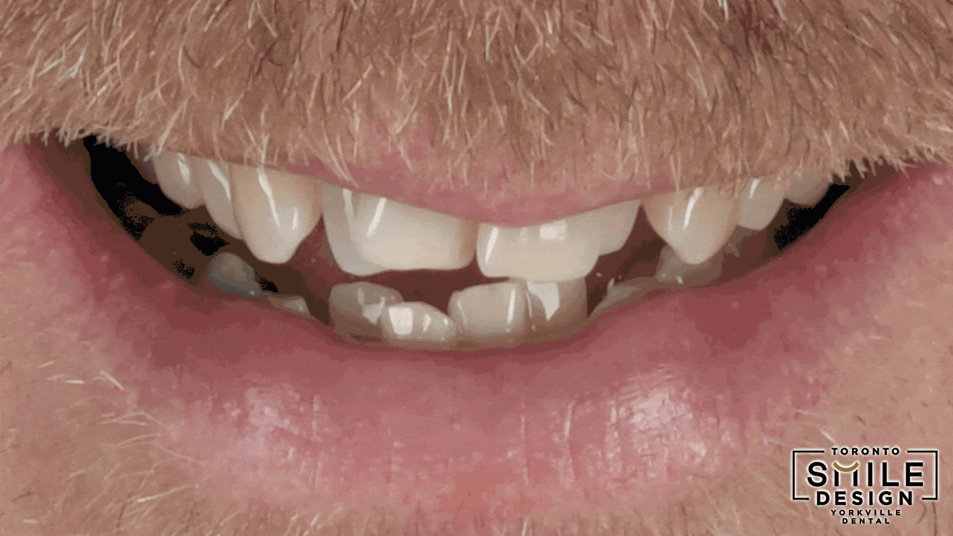 Before-and-after centre-view portrait GIF showing the final Smile Makeover Toronto result after advanced Digital Smile Design at Toronto Smile Design – Yorkville Dental. This dynamic image highlights improved gumline symmetry, enhanced lip support, corrected crowded teeth, and a more balanced smile-to-face relationship achieved through meticulous cosmetic dentistry planning and execution.