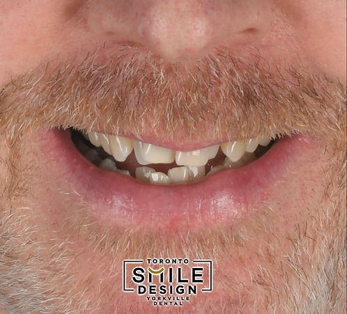Frontal portrait of a male patient in his 50s to 60s before beginning a complex Smile Makeover Toronto treatment at Toronto Smile Design – Yorkville Dental. This initial facial photograph was part of the digital patient documentation used for Cosmetic Dentistry planning, helping evaluate facial balance, smile harmony, and the relationship between the lips, teeth, and overall facial structure before treatment.
