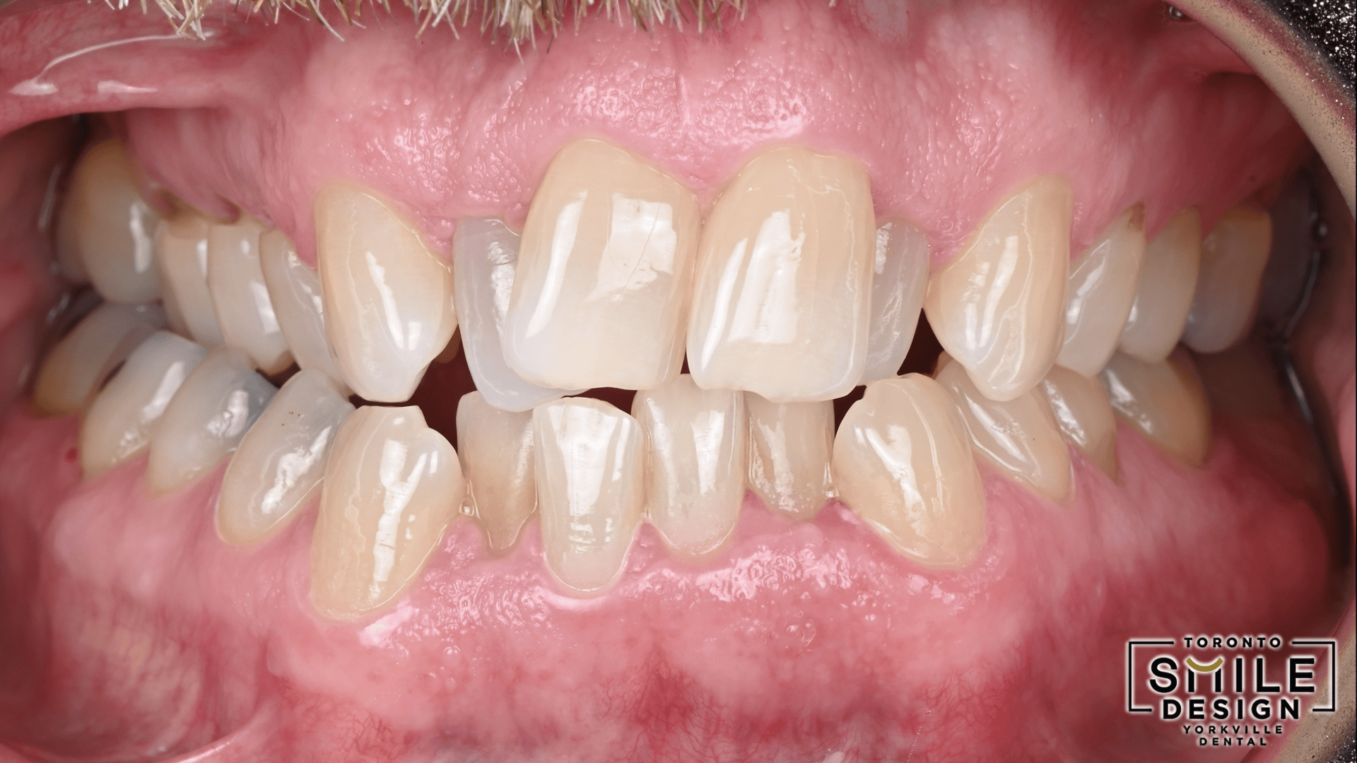 Before-and-after centre-view intraoral GIF showing the final Smile Makeover Toronto result after advanced Digital Smile Design at Toronto Smile Design – Yorkville Dental. This dynamic image highlights corrected crowded teeth, improved gumline symmetry, refined tooth proportions, and a more harmonious restorative outcome achieved through meticulous cosmetic dentistry planning and execution.